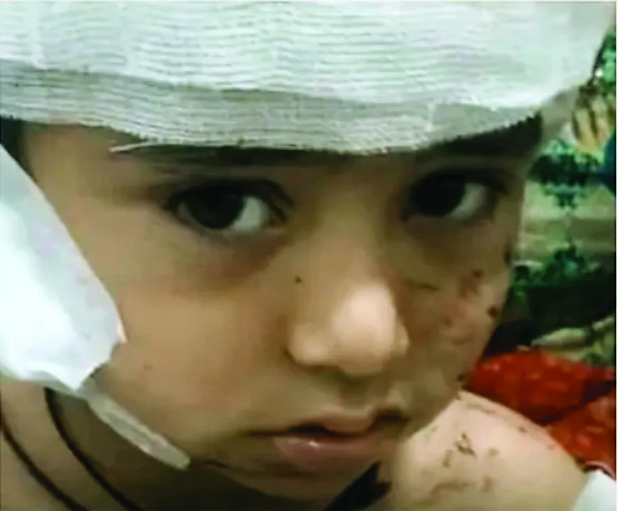  बीकानेर स्कूल हादसा: पहले दिन 4 साल के मासूम पर कुत्तों का हमला, सिर की चमड़ी नोची, पीबीएम में सर्जरी 