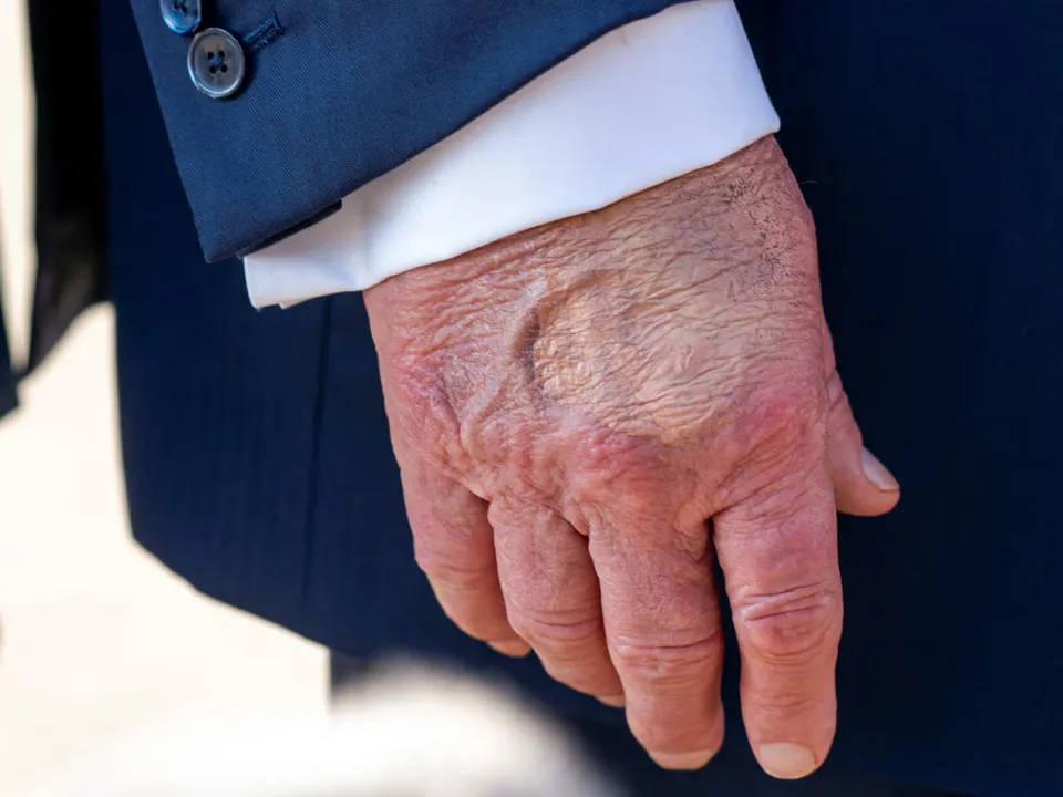   donald-trump-health-vein-disease-update 