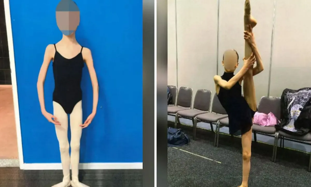  The girl at 16 had weighed just 27 kg and was in a condition so alarming that she required hospitalization with tube feeding. Photograph: (HT) 