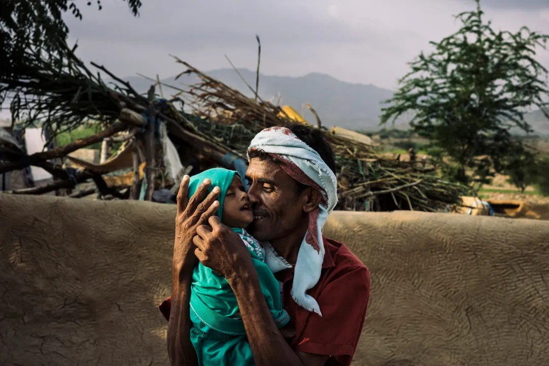  Yemen Jeopardy: Over 5 years of Civil War, survival chances of the Famine hit middle east country are none.