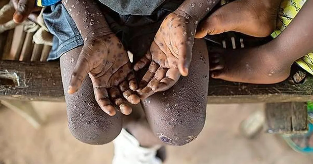  India ups surveillance & testing, WHO holds emergency meeting after Monkey Pox outbreak spreads across globe