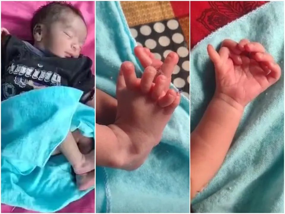  Baby girl born with 12 toes and 14 fingers in Rajasthan