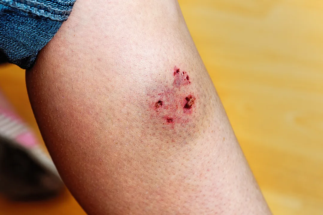  High Court decrees Rs 10,000 compensation per tooth mark for dog bite victims