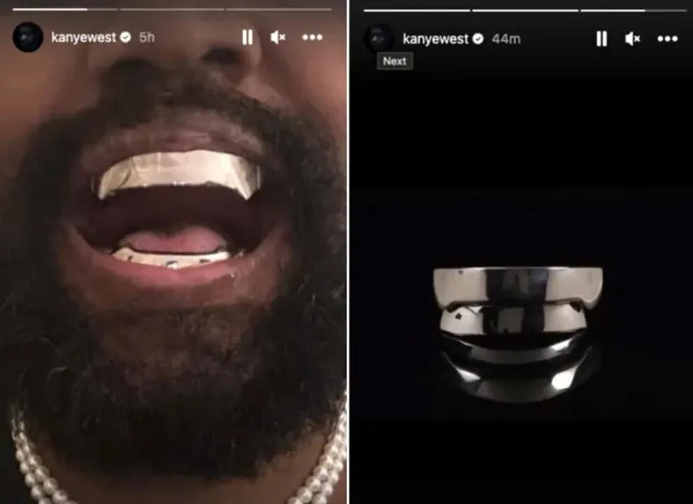  Kanye gets titanium teeth, daughter North gets diamond grills!