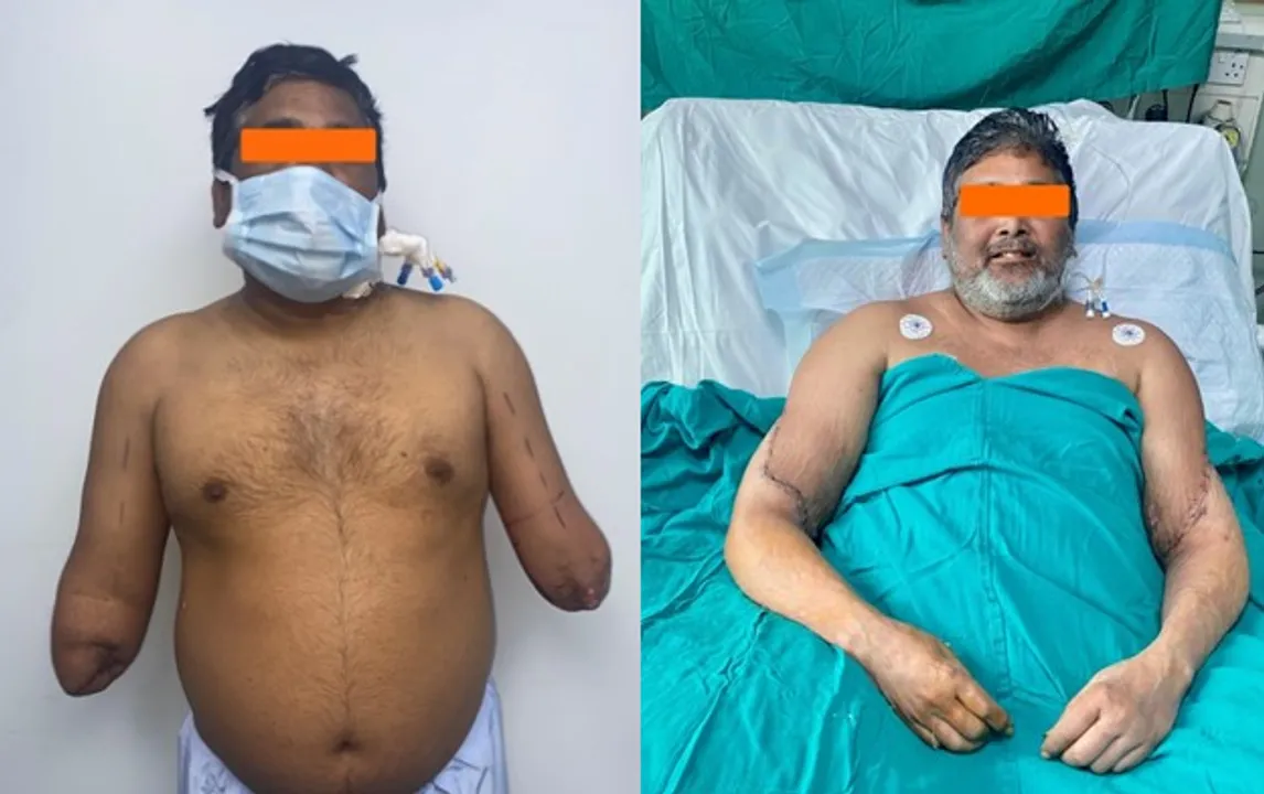  Delhi painter's hands restored through organ donation and surgical expertise