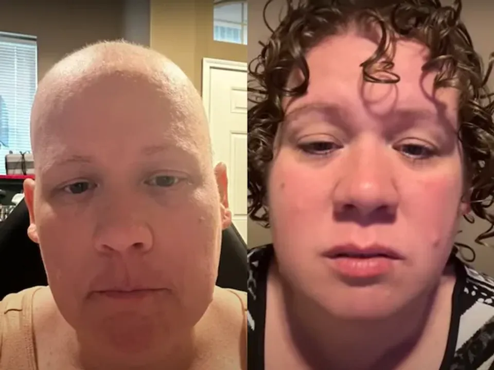  US Woman undergoes painful Chemotherapy only to find out cancer diagnosis to be false