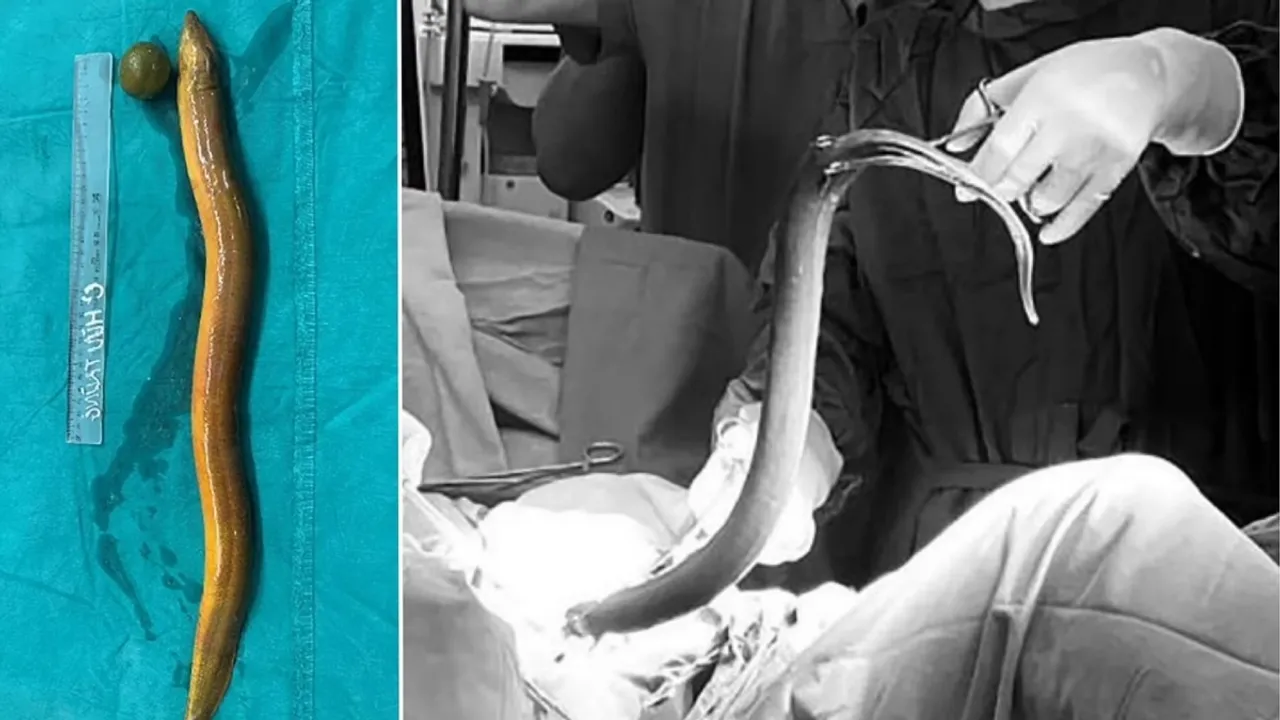  Indian national in Vietnam hospitalized after inserting Eel in rectum