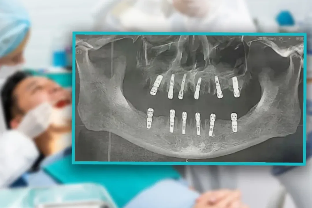  Chinese man dies of heart attack 13 days after major dental procedure
