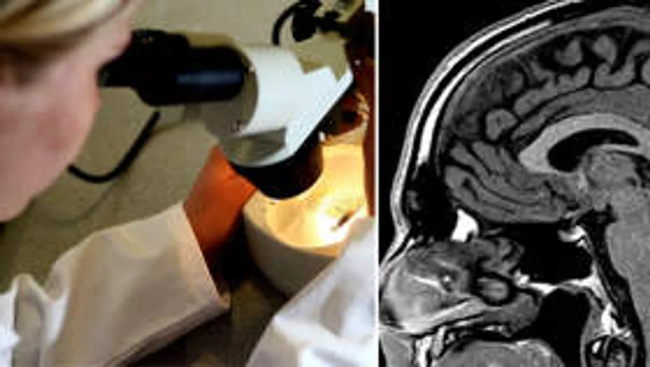  Breakthrough blood test diagnoses deadly brain cancers in just 60 minutes