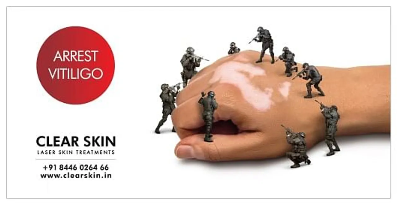 ARREST VITILIGO