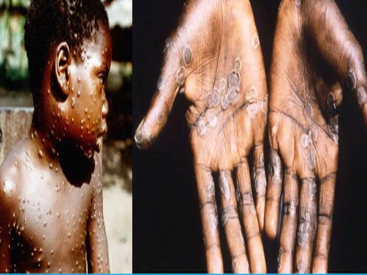 মাঙ্কিপক্স নিয়ে সতর্ক রাজ্য