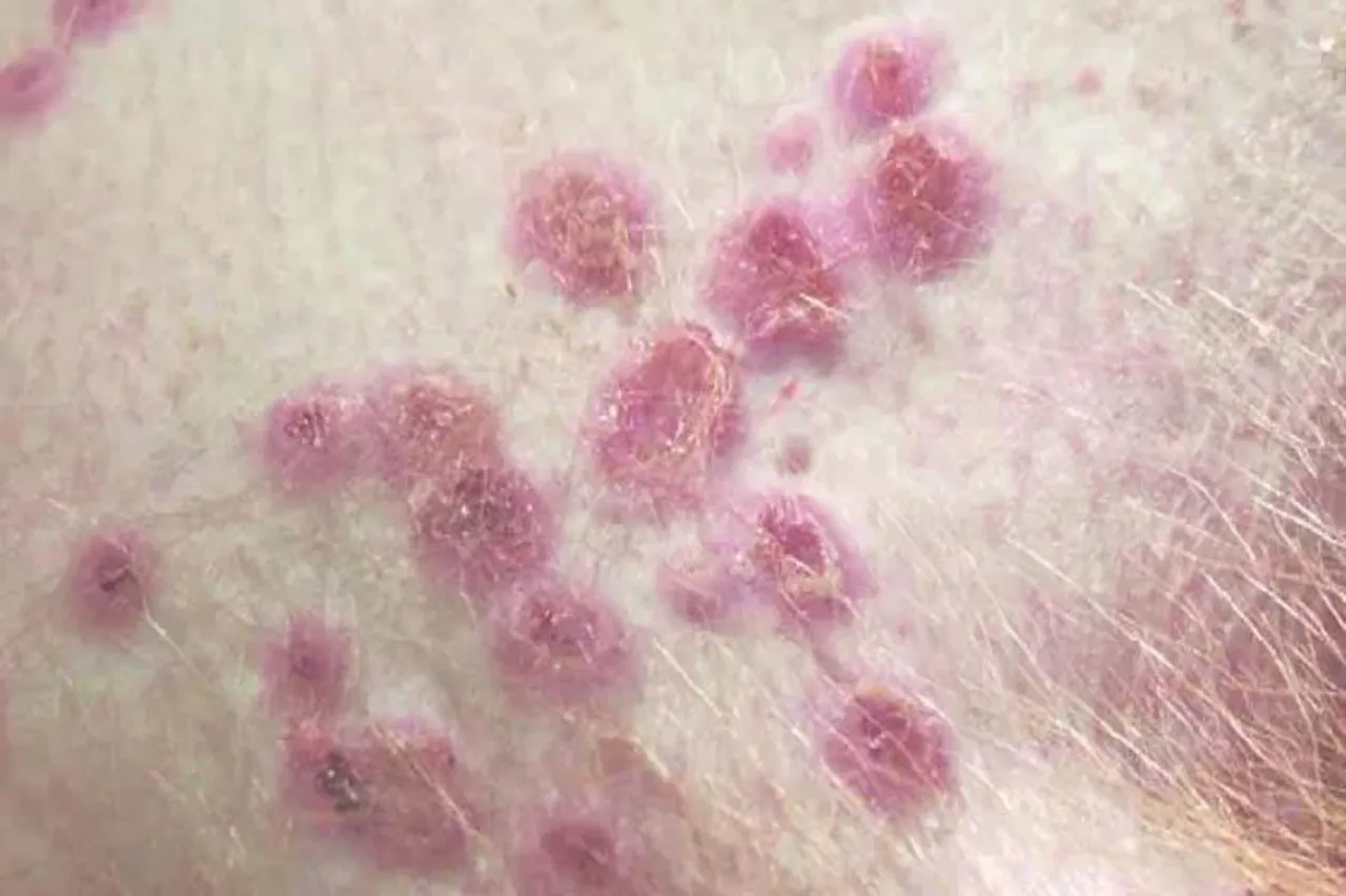 মাঙ্কিপক্স পরিস্থিতি নিরীক্ষণের জন্য গঠিত হল টাস্ক ফোর্স