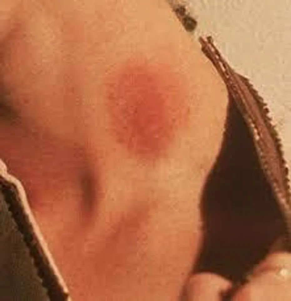 হিকি কি বেদনাদায়ক?