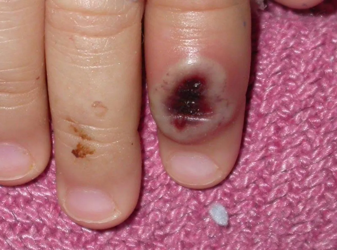 এবার মাঙ্কিপক্সের হদিশ মিলল অস্ট্রেলিয়ায়