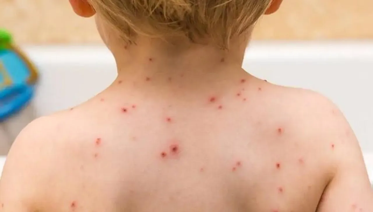 এবার চিনে ঢুকে পড়ল মাঙ্কিপক্স