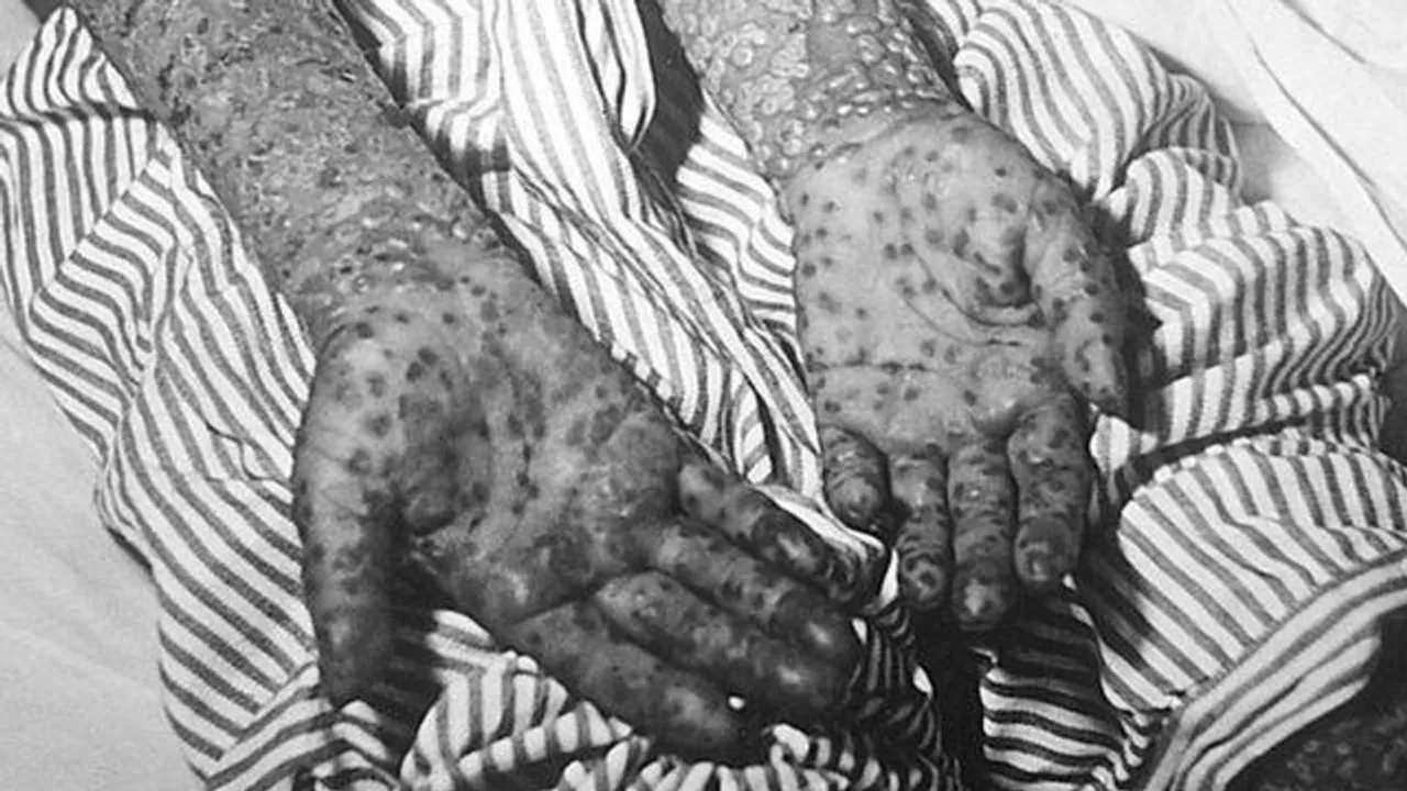 প্রাণঘাতী চিকেন পক্স