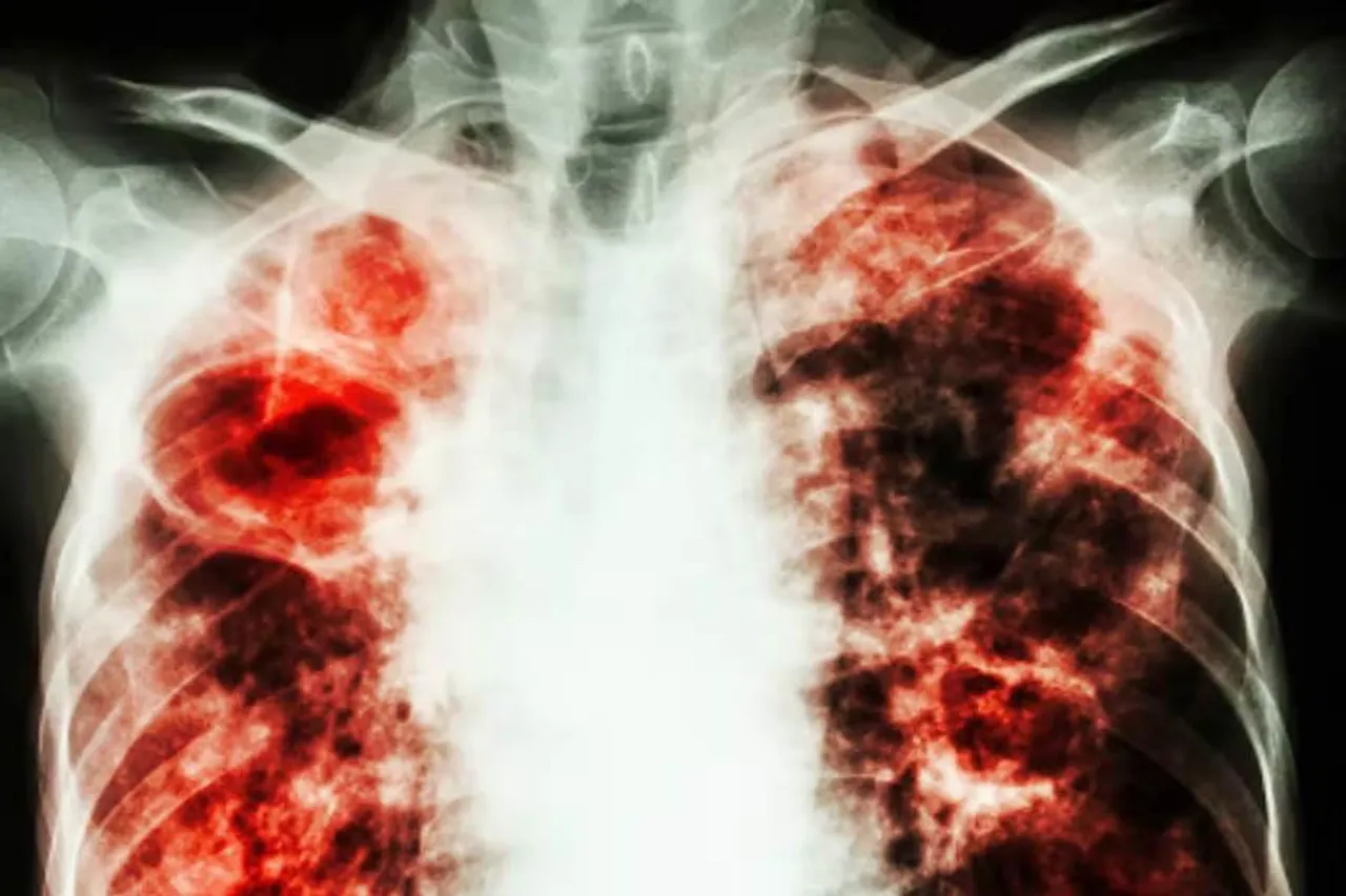 ২৪ মার্চঃ বিশ্ব যক্ষ্মা দিবস