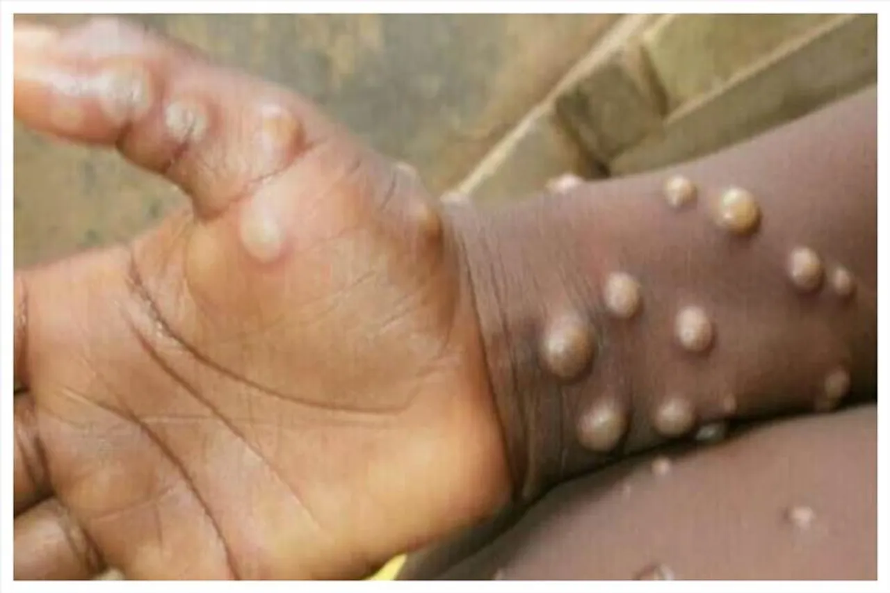 মাঙ্কিপক্সের কারণে প্রথম মৃত্যু আমেরিকায়