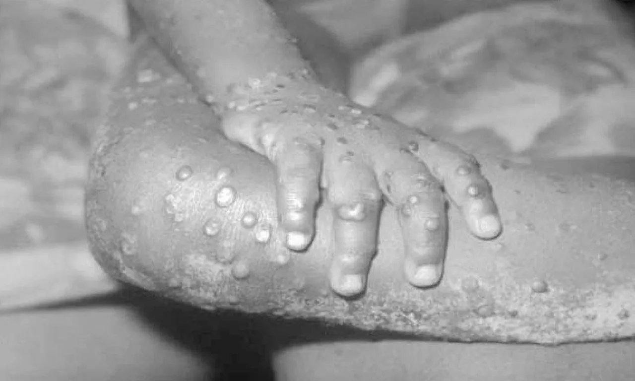 এবার চিনে হানা দিল মাঙ্কি ভাইরাস! মৃত