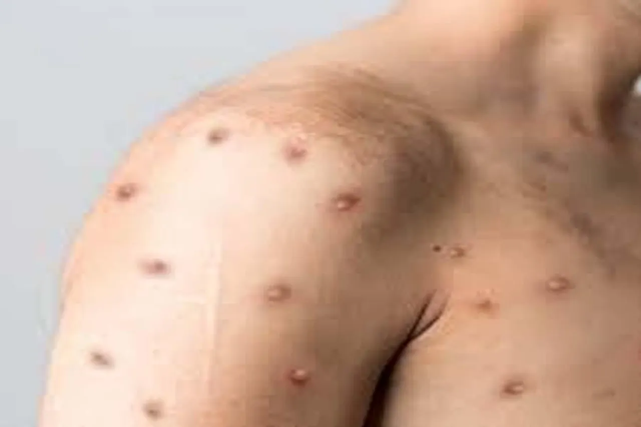 Monkey Pox attack in the country again