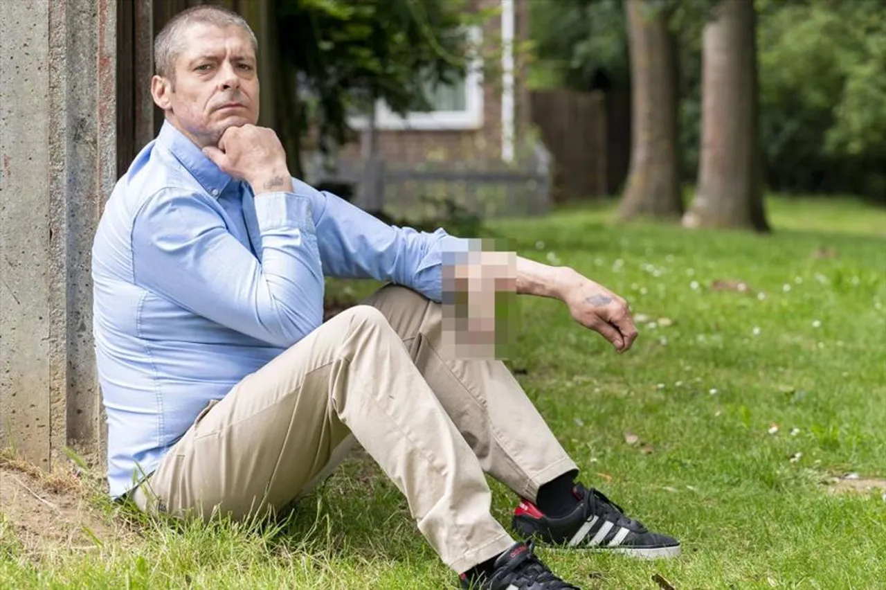 A US man lost 1.5 inches of his penis after Covid