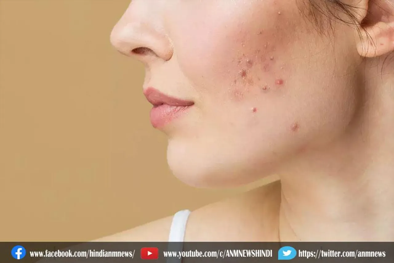 एंटी पिंपल्स ड्रिंक्स से मिलेगी राहत