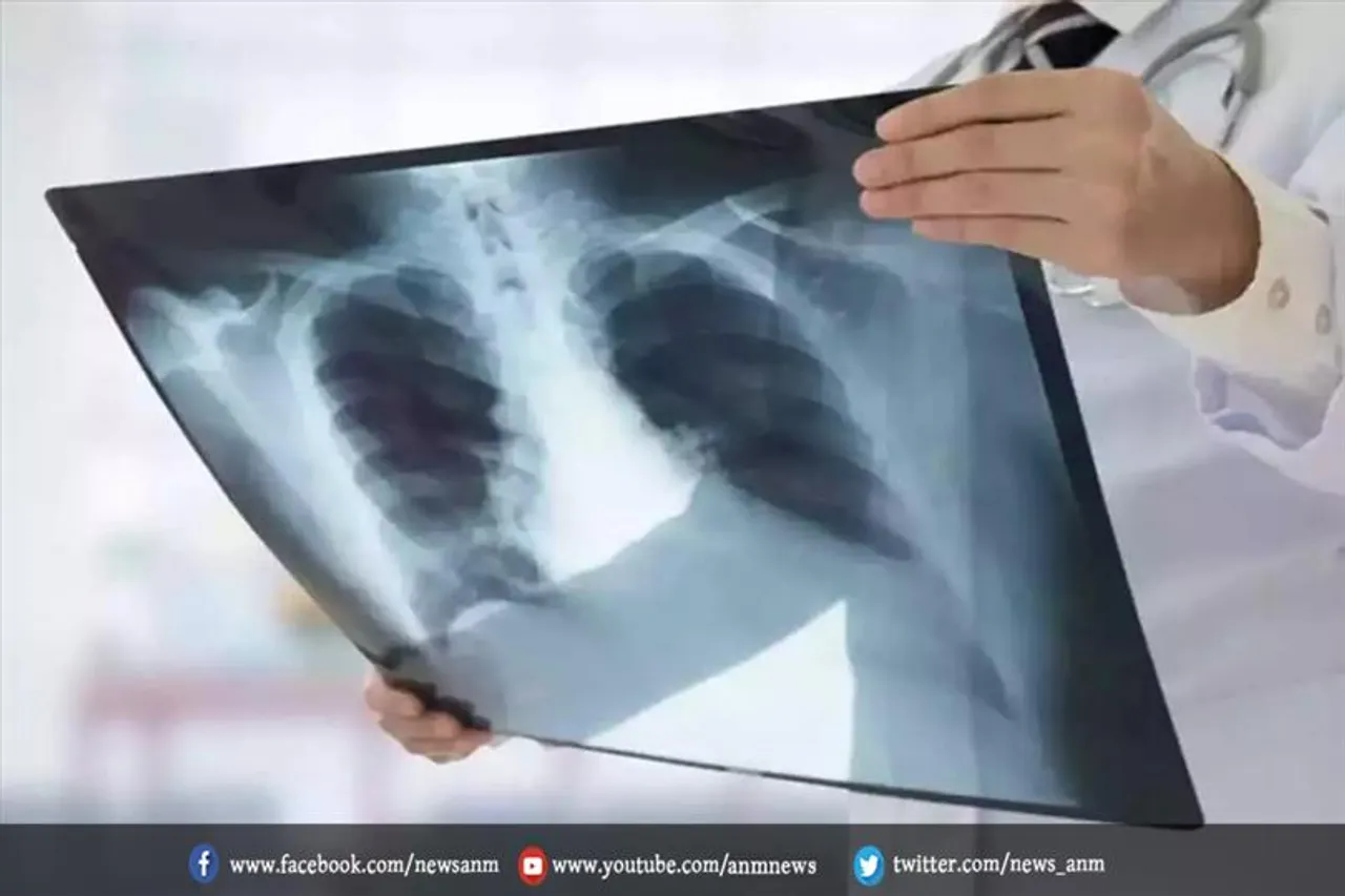 एक्स-रे के माध्यम से अब होगा कोरोना का जांच