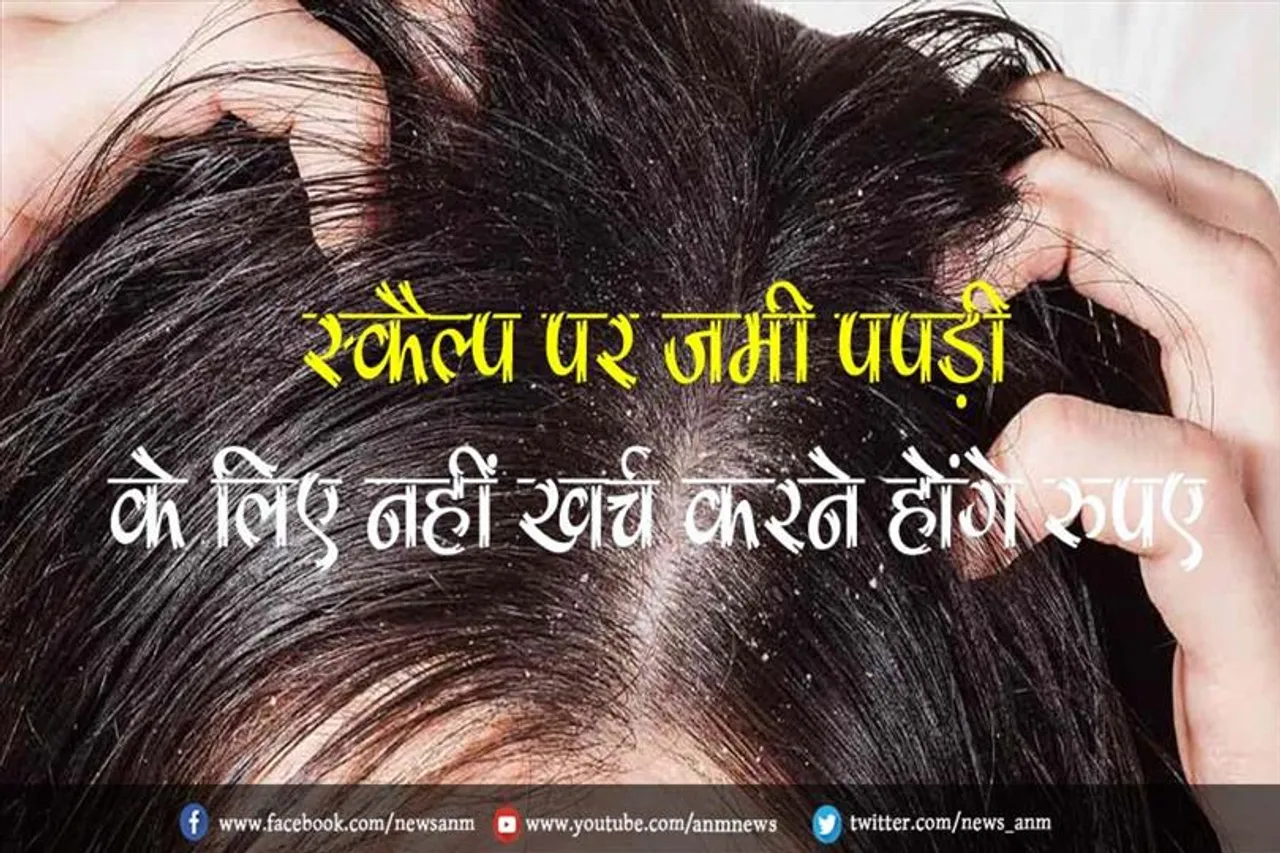 स्कैल्प पर जमी पपड़ी के लिए नहीं खर्च करने होंगे रुपए