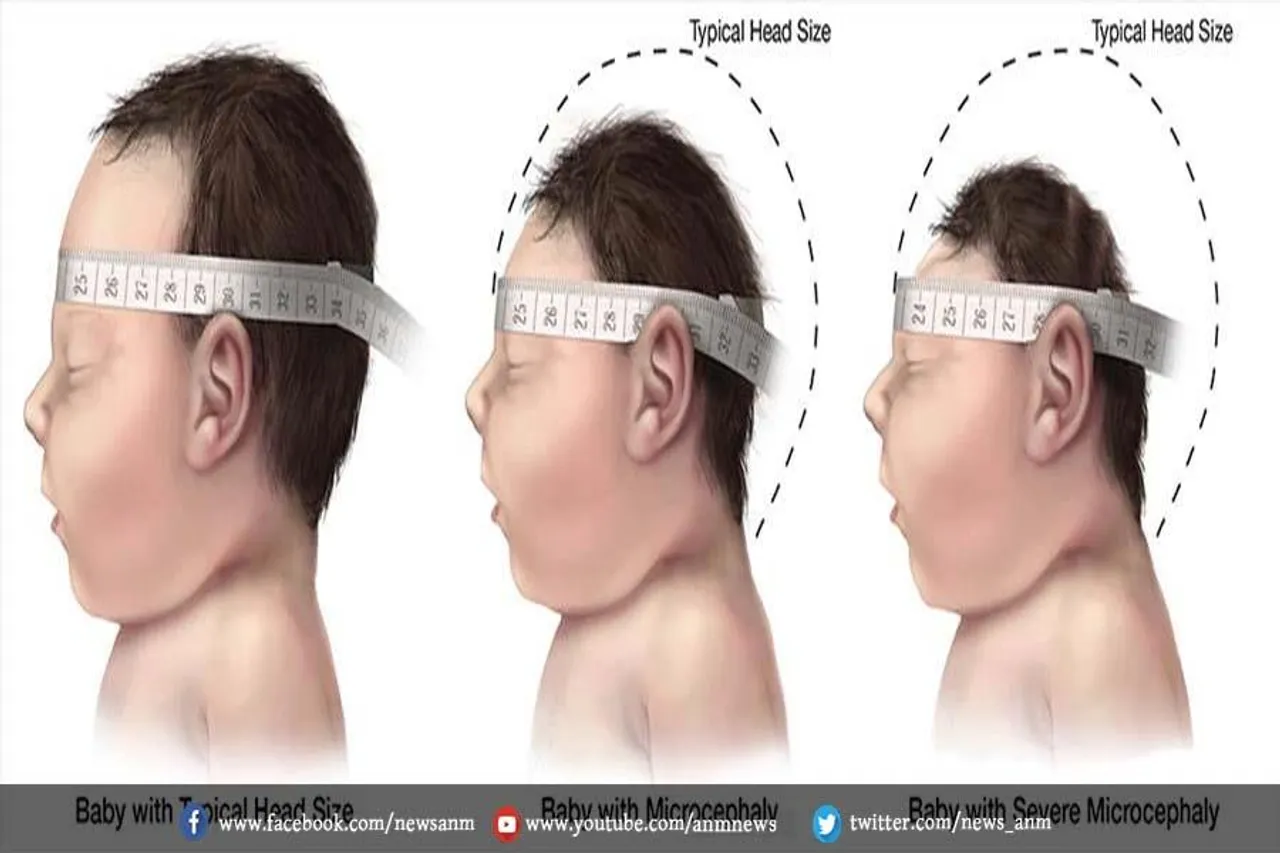 क्या आप जन्मजात जीका सिंड्रोम के बारे में जानते हैं