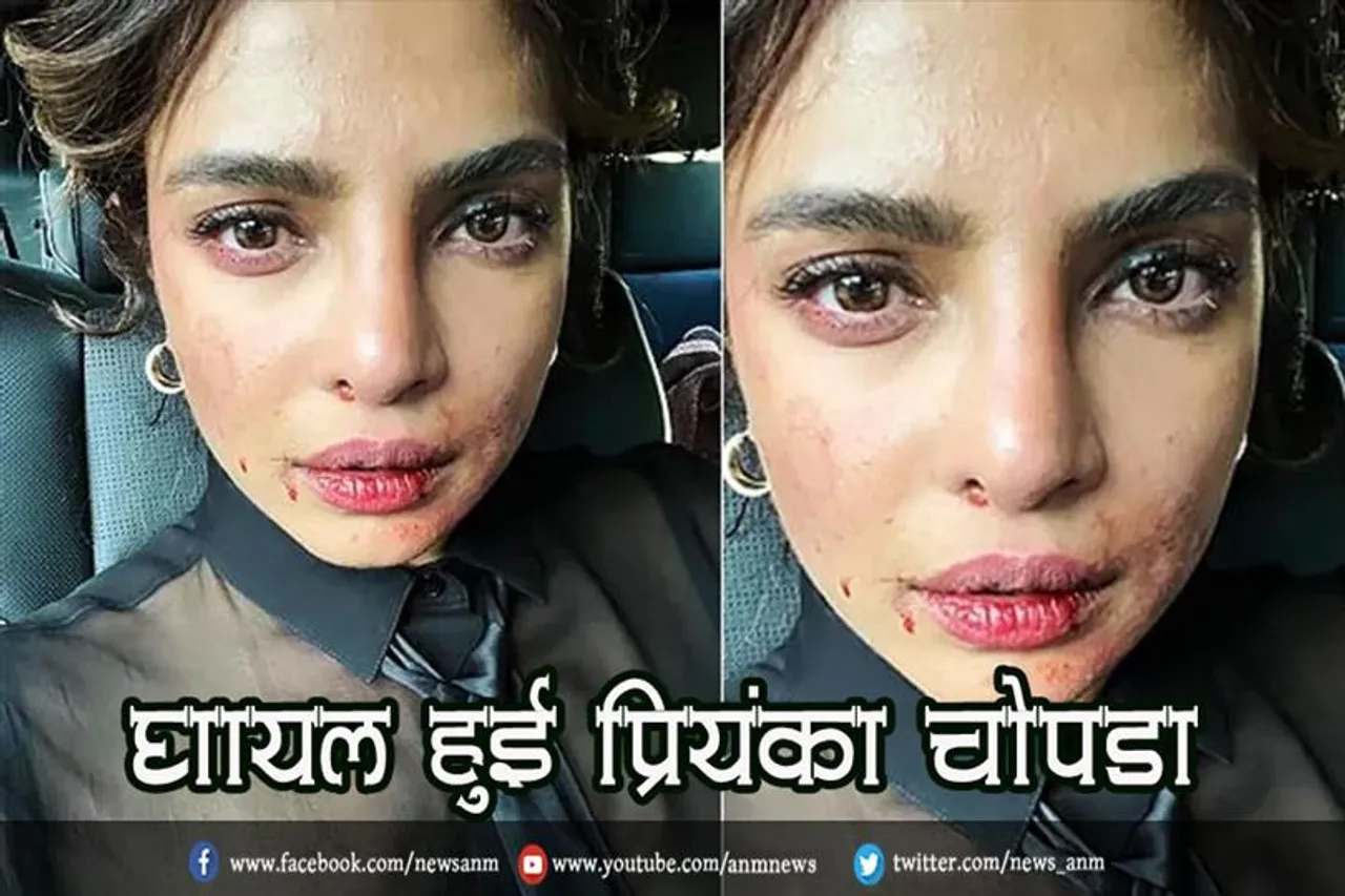 घायल हुई प्रियंका चोपड़ा