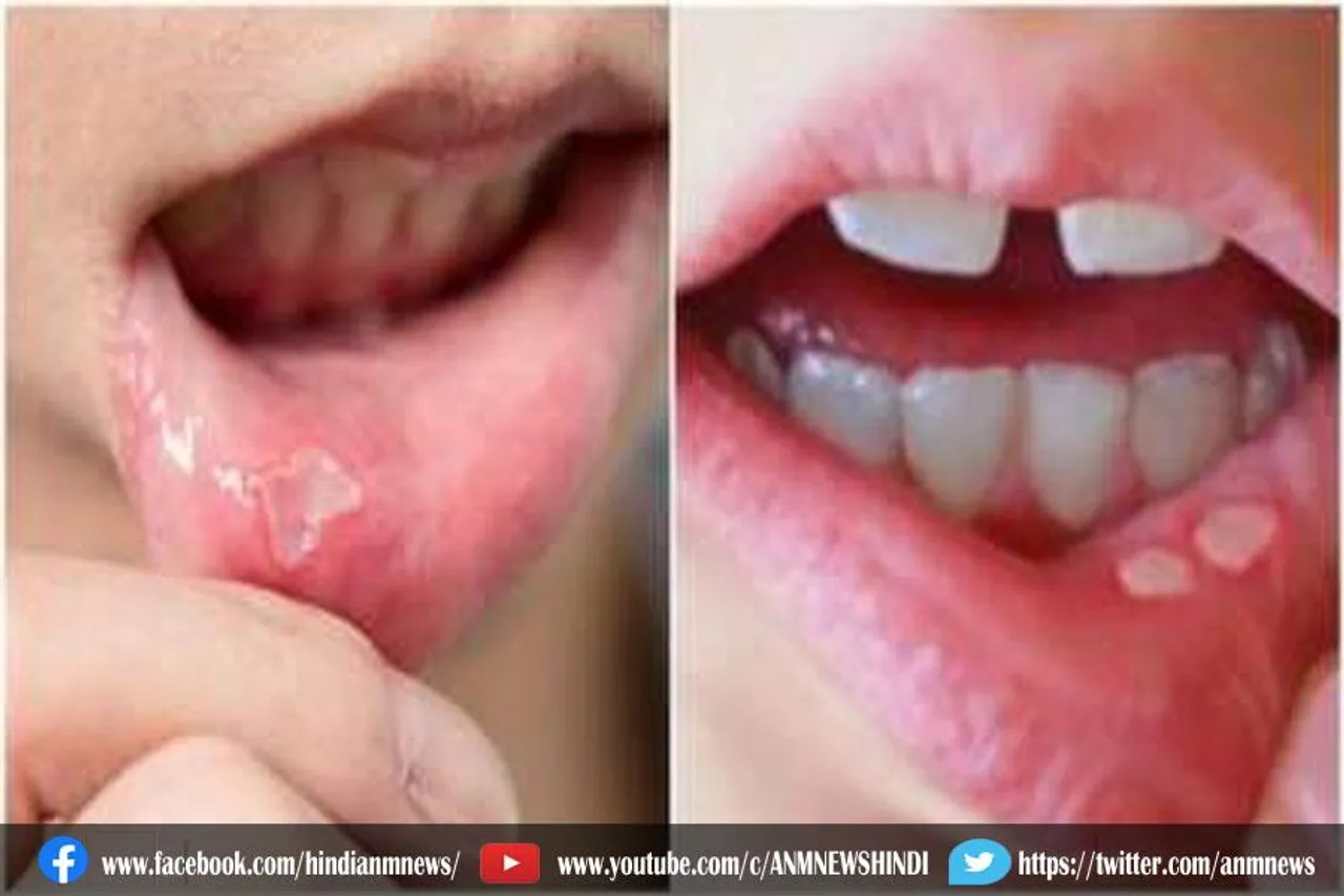 मुंह के छालों से छुटकारा पाने के उपाय