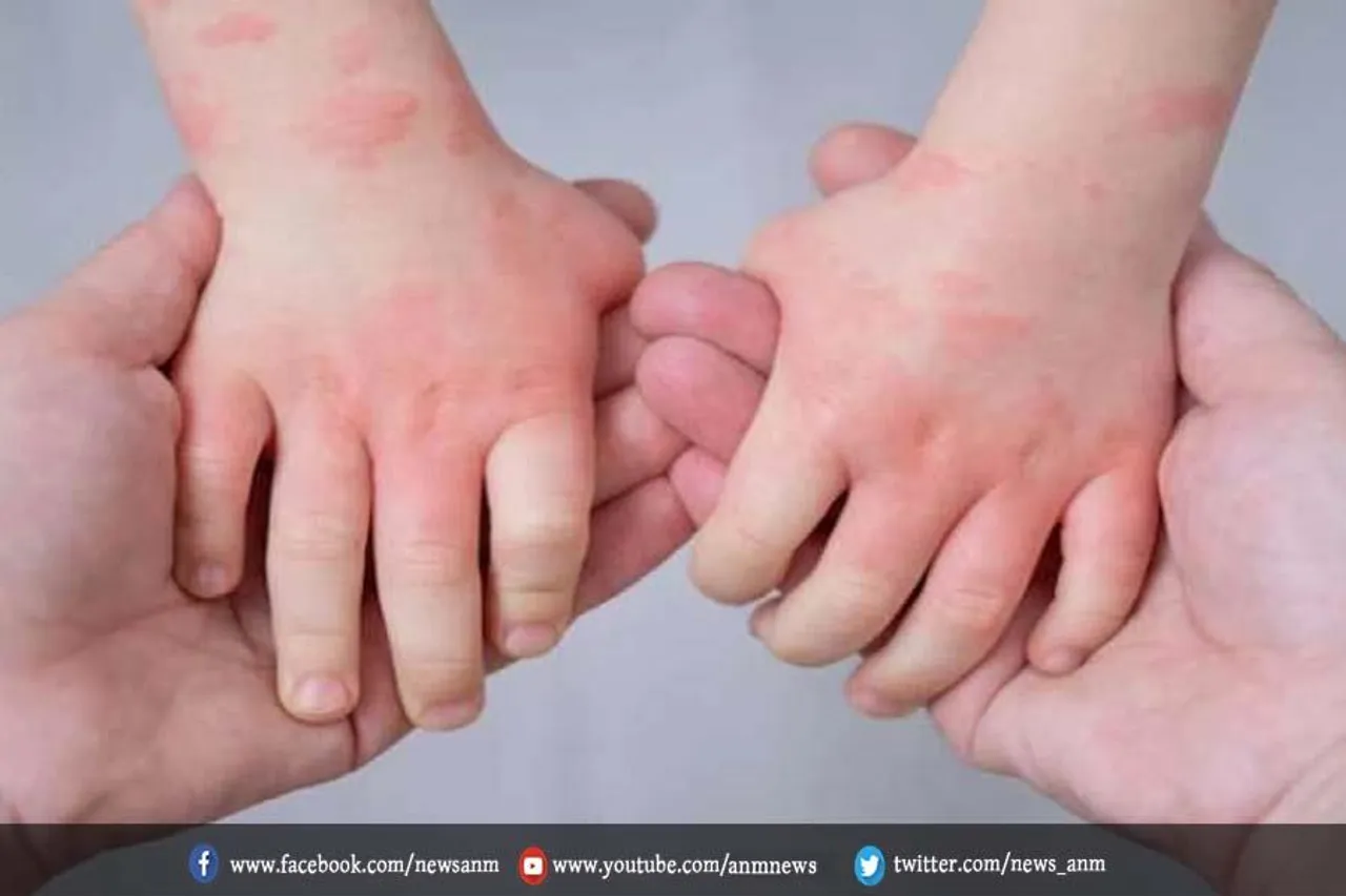 मेरठ में टोमेटो फ्लू को लेकर अलर्ट जारी