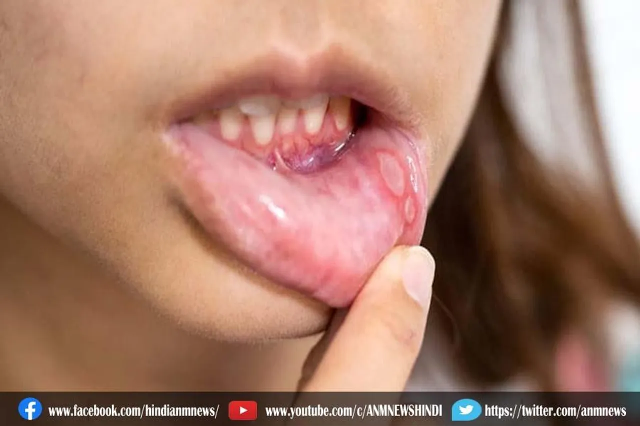 मुंह के छाले से है परेशान, खाए ये फूड