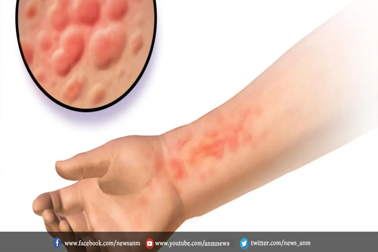 जानिए, क्या है एक्जिमा के सामान्य लक्षण