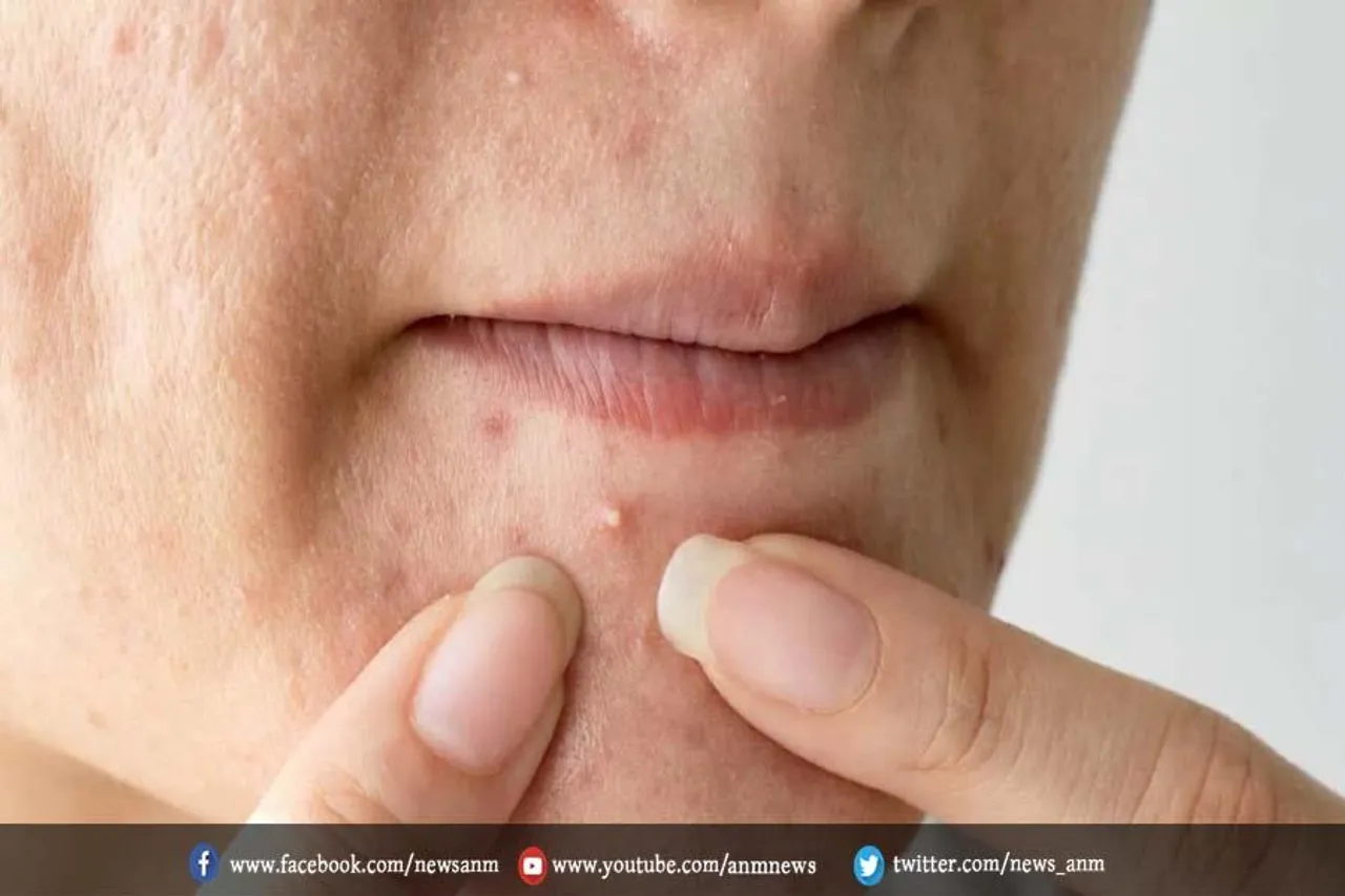 क्या आप पिंपल्स से परेशान हैं तो करे ये काम