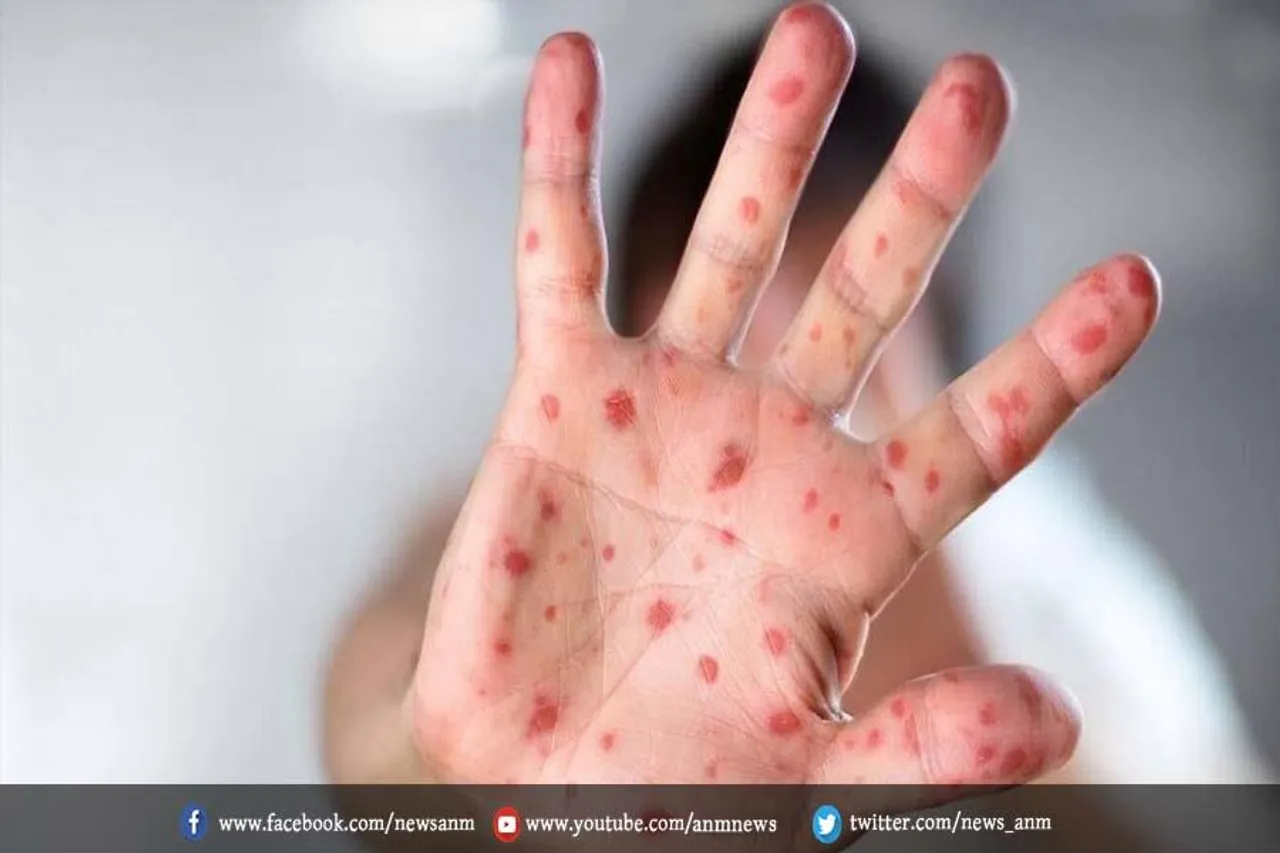 भारत में मंकीपॉक्स का बढ़ता ग्राफ