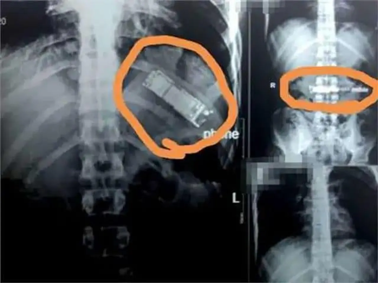 6 महीने से पेट में मोबाईल लेकर घूम रहा था शख्स