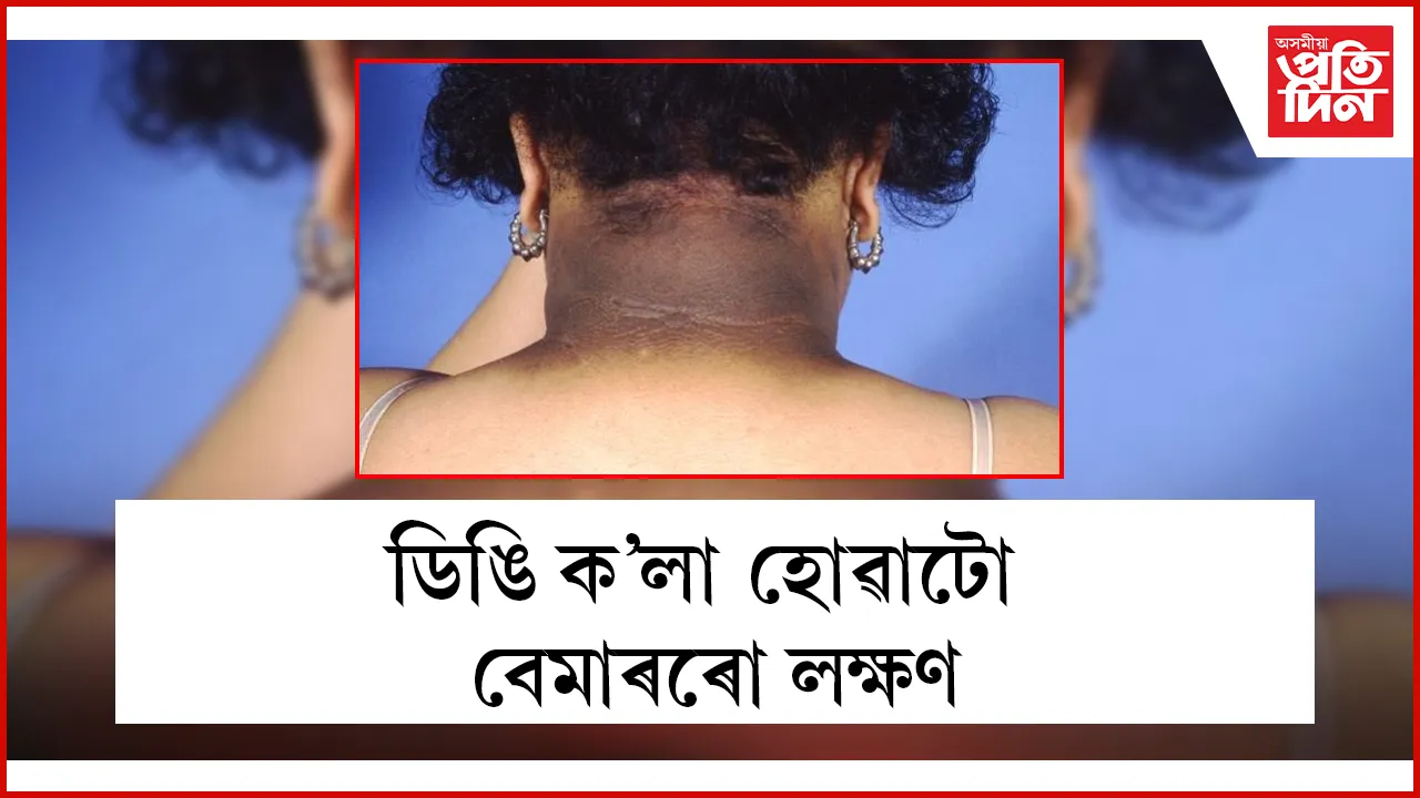 বেমাৰৰো লক্ষণ seo