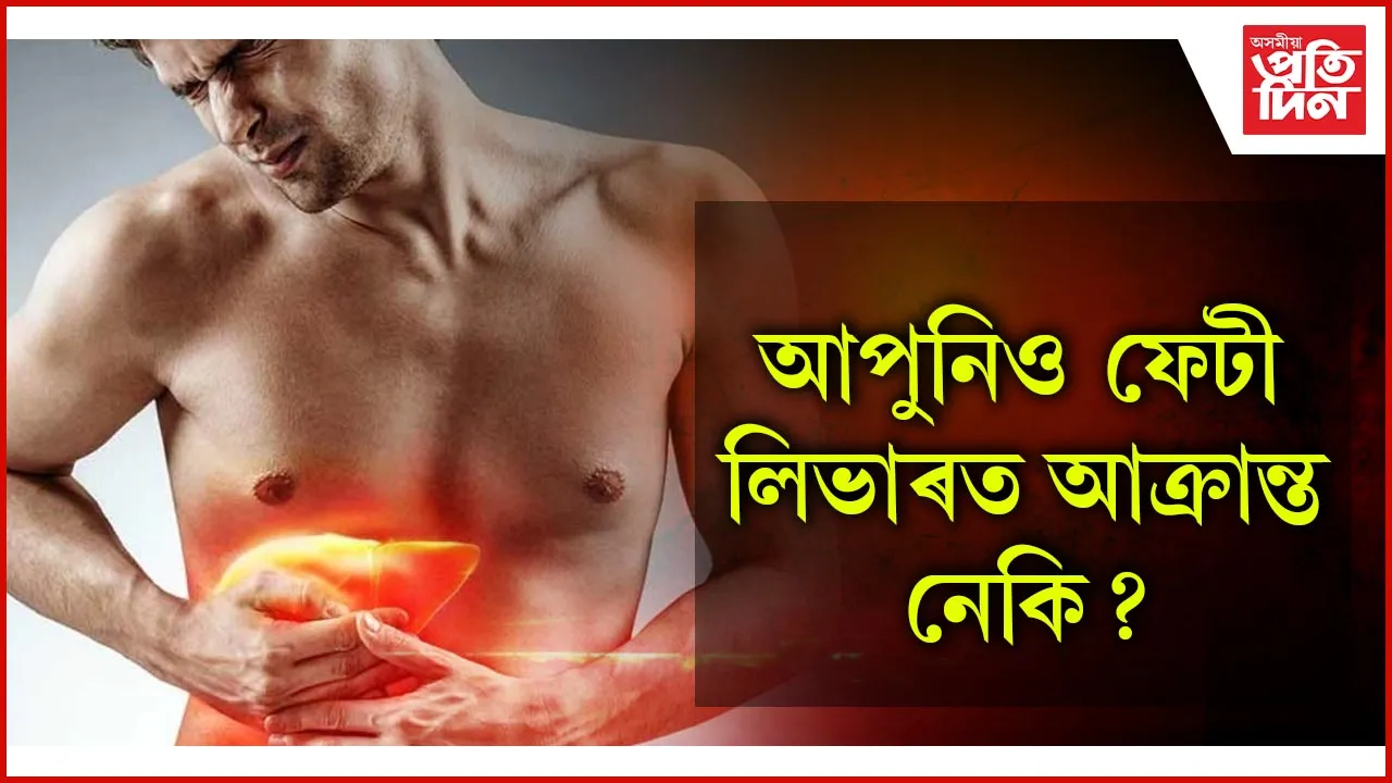 ফেটী লিভাৰ