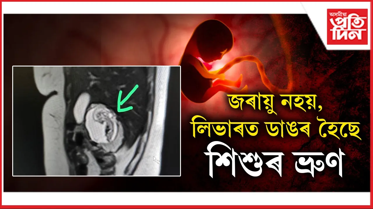 শিশুৰ ভ্ৰুণ