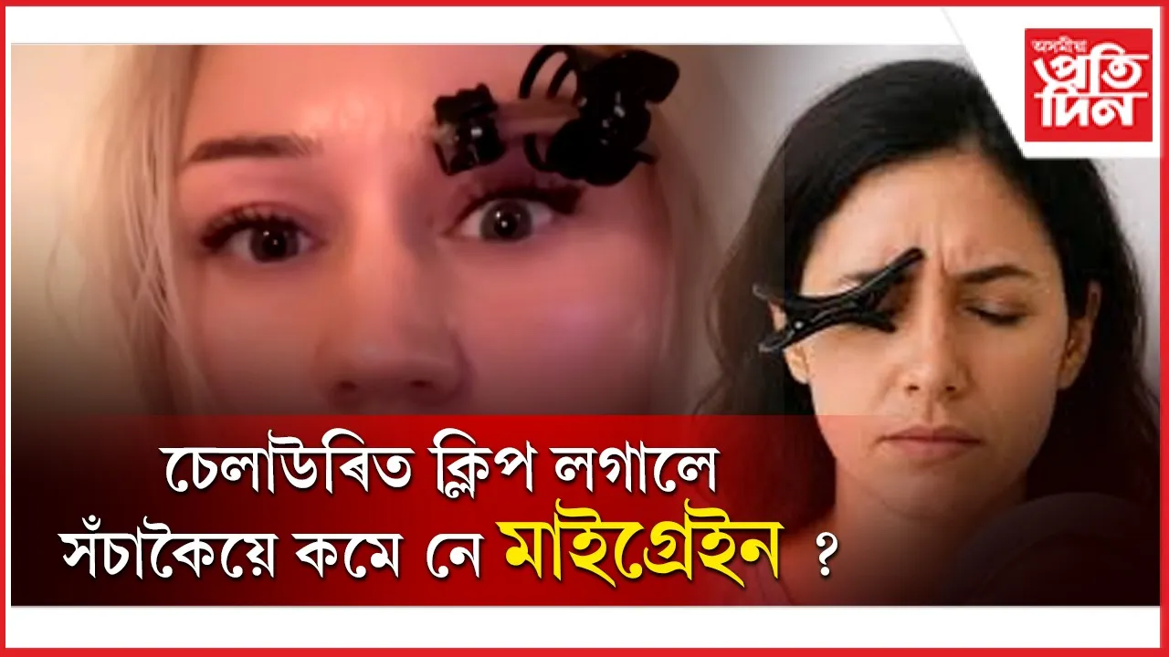 মাইগ্ৰেইন