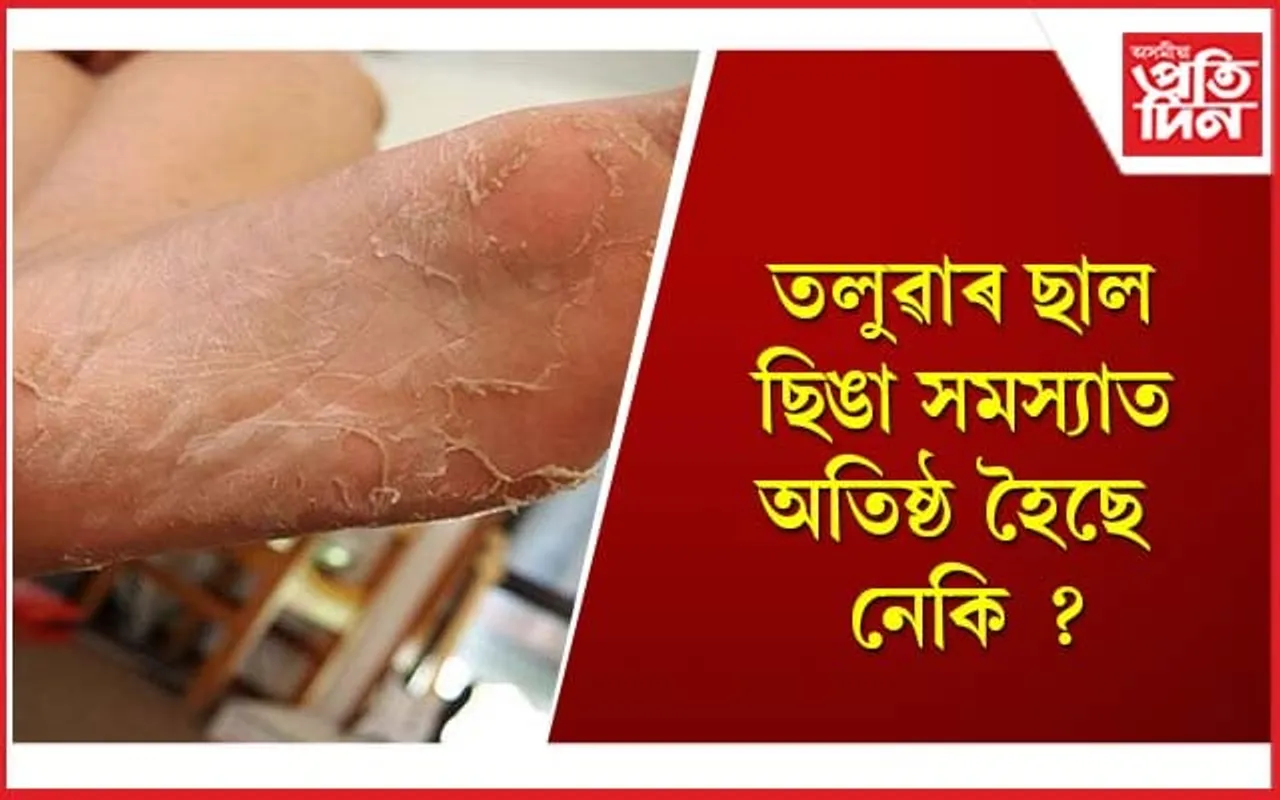 এই সমস্যাৰ পৰা কিদৰে হাত সাৰিব পাৰি জানি লওঁক