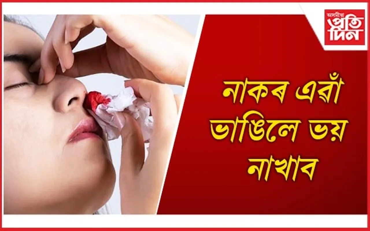 ঘৰতে কৰিব পাৰি নাকৰ ৰক্তক্ষৰণৰ চিকিৎসা