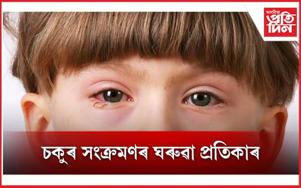 ‘পিংক আই’ৰ পৰা বাচিবলৈ এইসমূহ সাৱধানতা অৱলম্বন কৰক