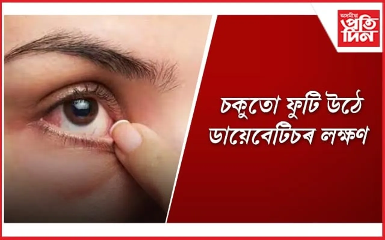 চকুত এইসমূহ অসুবিধাই দেখা দিলে সাৱধান হ’ব