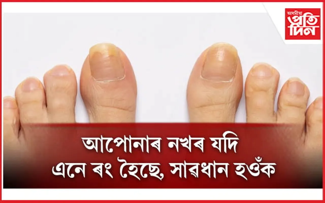 বহু ৰোগৰ লক্ষণ দেখা যায় নখত, সলনি কৰক খাদ্য তালিকা