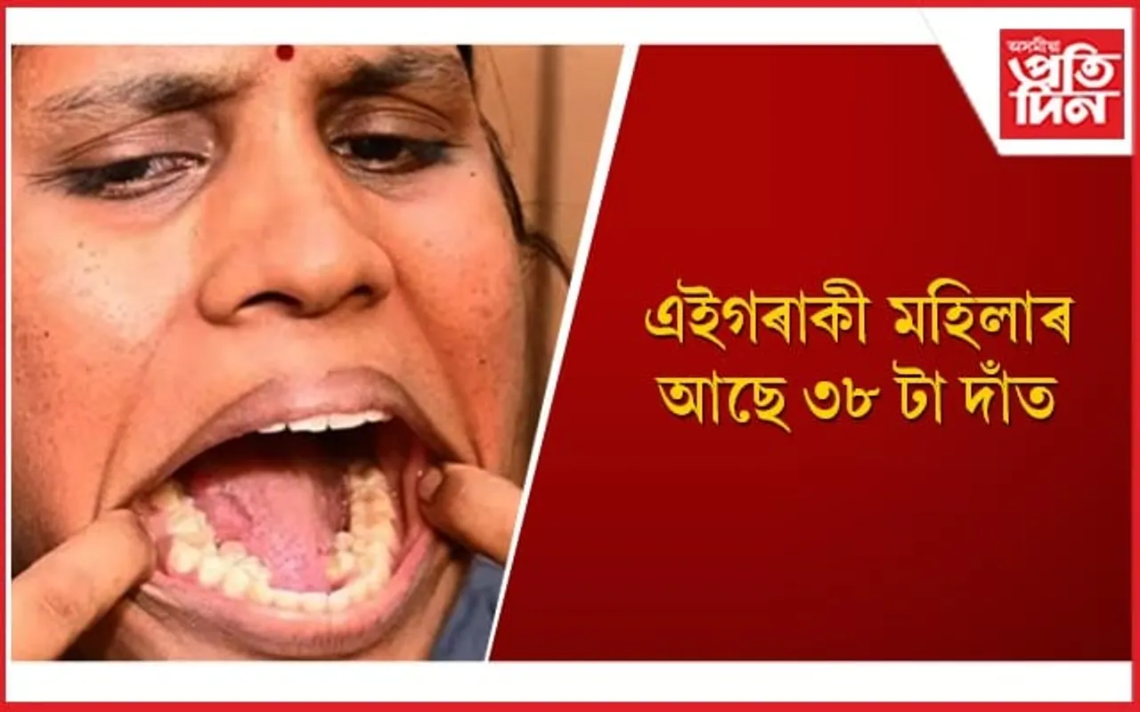 সৰ্বাধিক দাঁত থকা মহিলা হিচাপে বিশ্ব অভিলেখ গঢ়িলে ভাৰতৰ কল্পনাই
