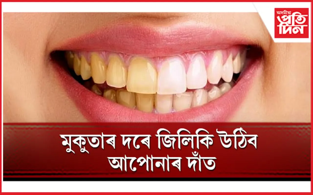 হালধীয়া দাঁতৰ বাবে লাজত পৰিছে  যদি এইসমূহ ঘৰুৱা উপায় অৱলম্বন কৰক