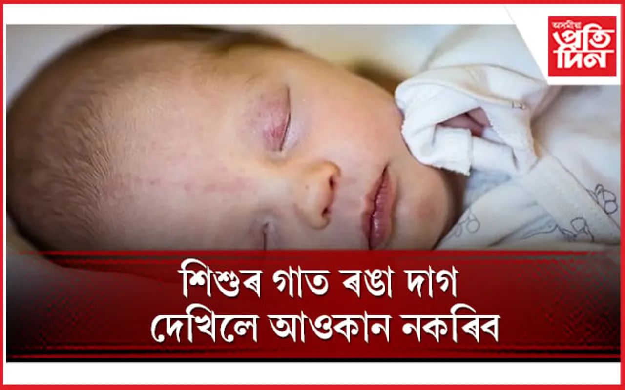 অভিভাৱকসকল সাৱধান হওঁক ! ই এক ৰোগৰ লক্ষণ  