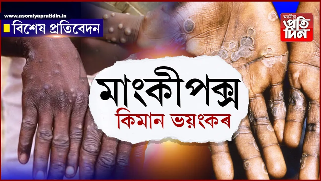মাংকীপক্স: আতংকিত নহয়,সজাগ হওঁক...